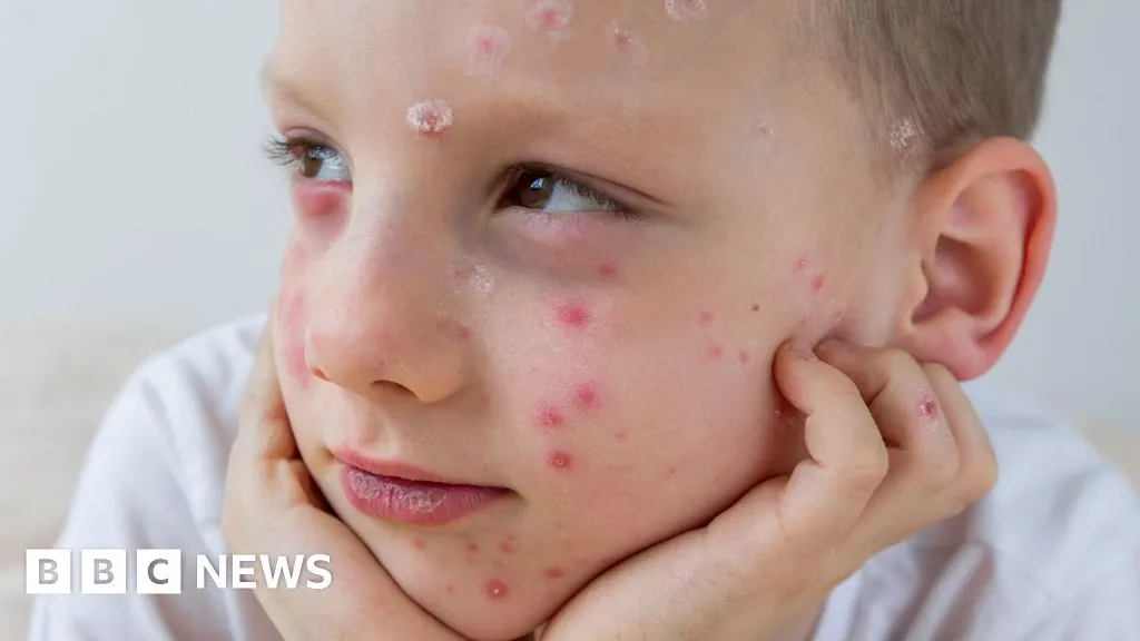 What is chickenpox and how can I get my child vaccinated?