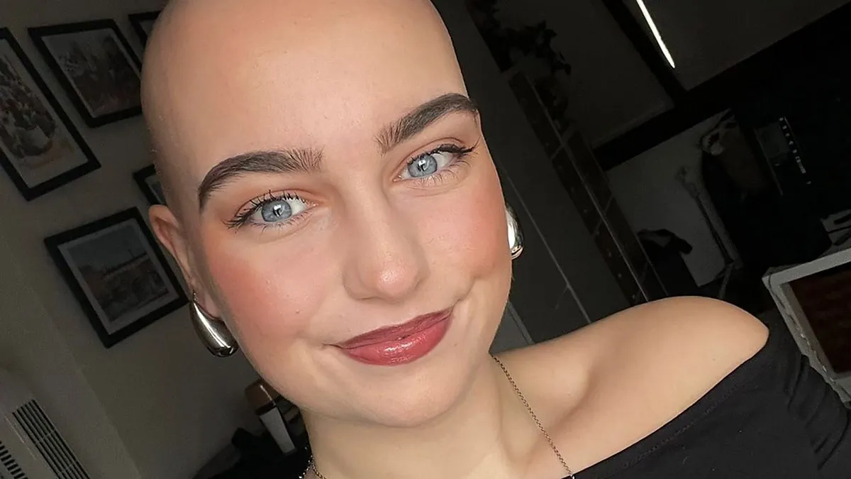 Women share stories of losing their hair